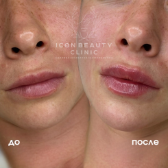 Контурная пластика губ 2